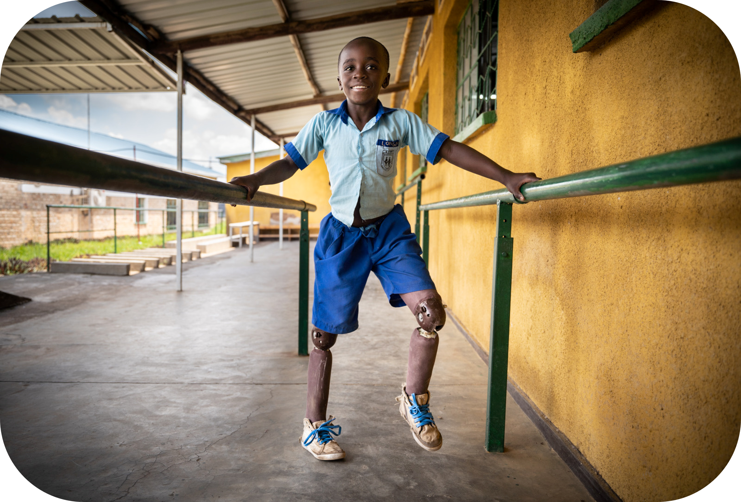 A child with a prosthesis stands on the parallel bars