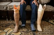 Hussein a été amputé suite à un bombardement. Il porte une prothèse. Il témoigne de ses difficultés en tant de personne handicapée à trouver une travail 